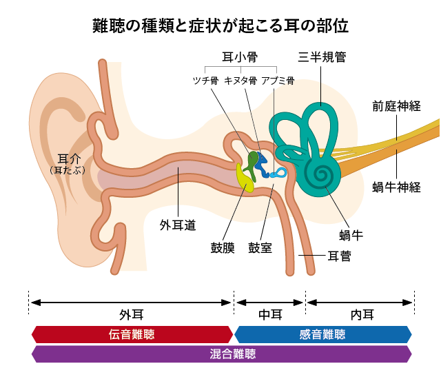 耳の部位による難聴の種類図