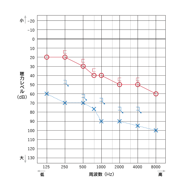 図解:気導聴力と骨導聴力のオージオグラム例